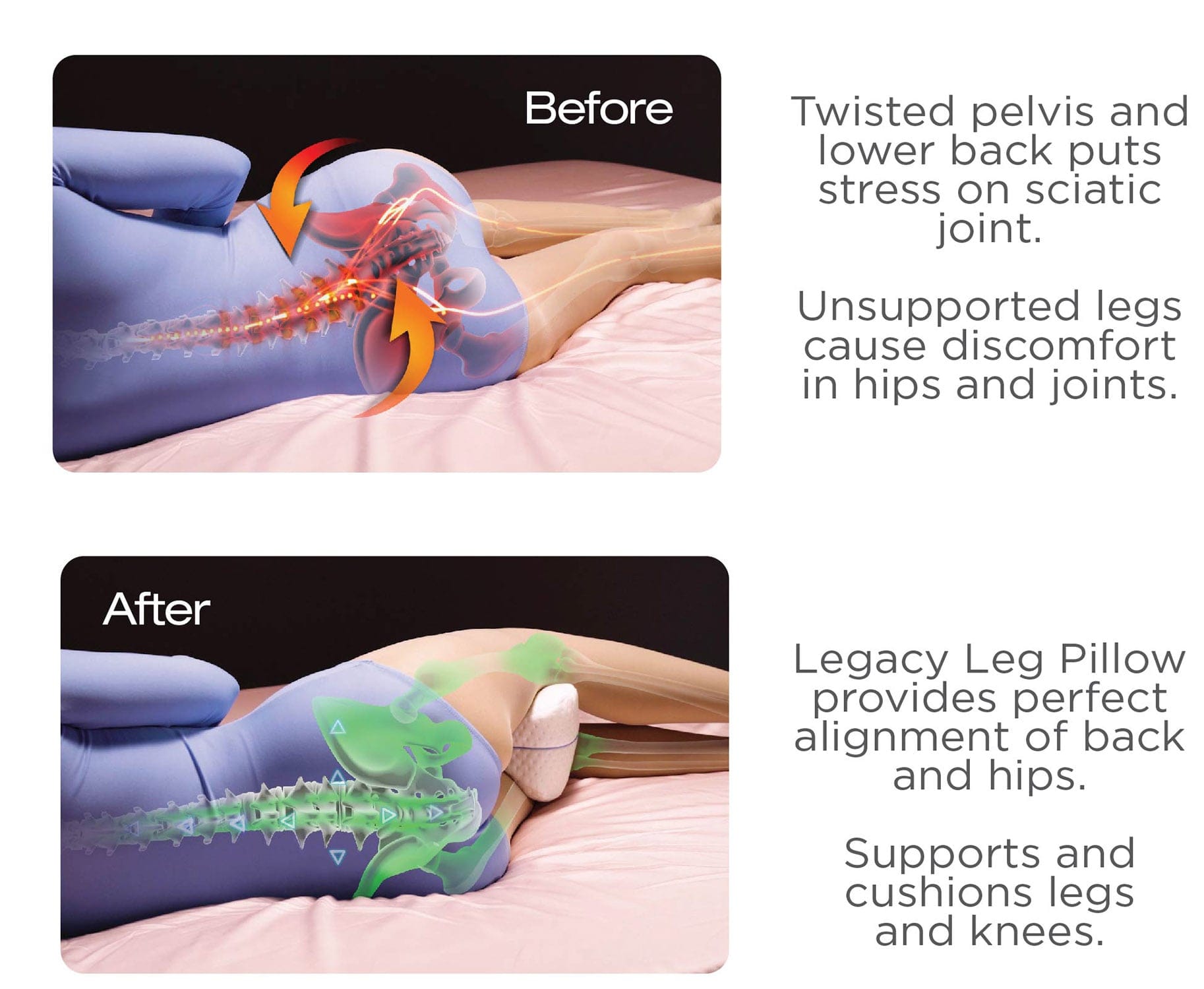 Before-and-after illustration comparing side-lying leg alignment without support and with the Contour Health Legacy Leg Pillow between the knees.
